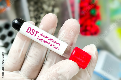 Dexamethasone Suppression Test measures the response of the adrenal glands to ACTH. Dexamethasone is given and levels of cortisol are measured photo