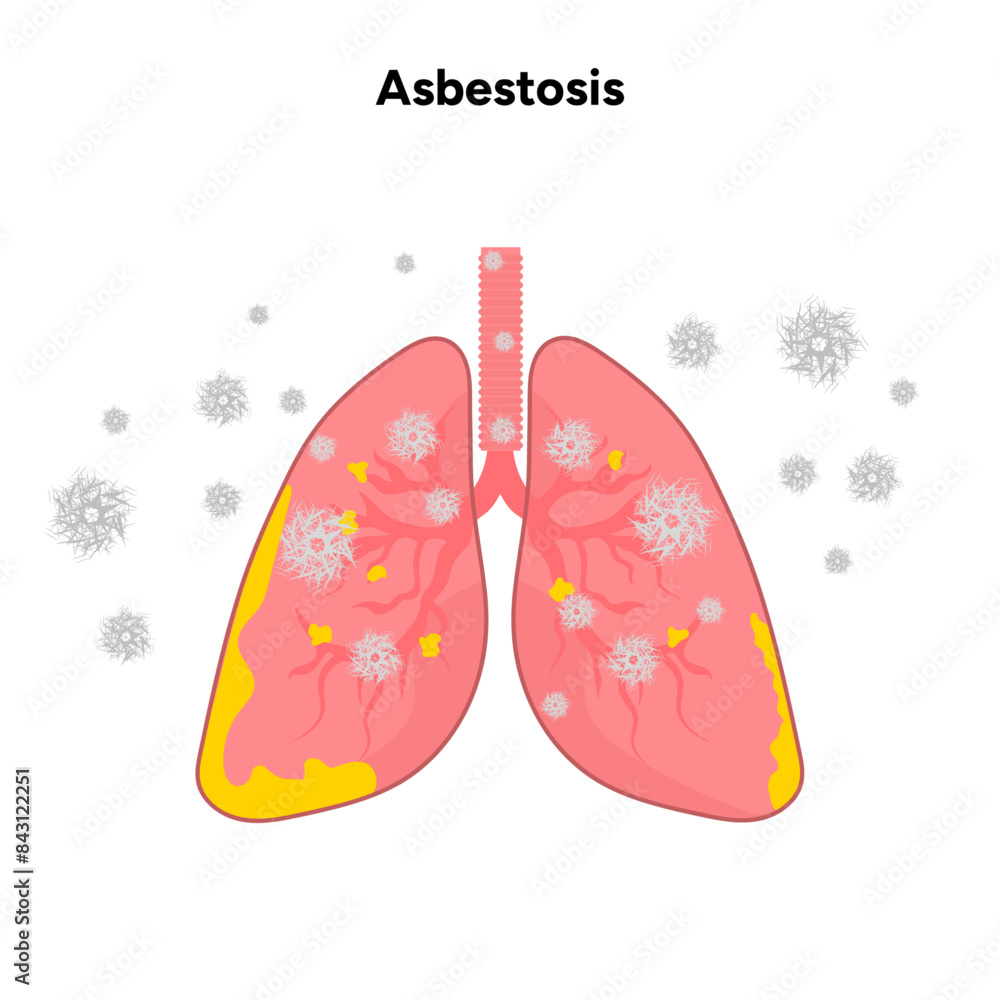Asbestosis lungs diseases, lungs problem Asbestosis lungs diseases, lungs problem