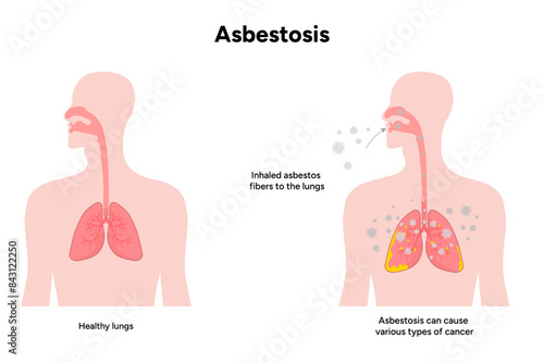 Asbestosis lungs diseases, lungs problem