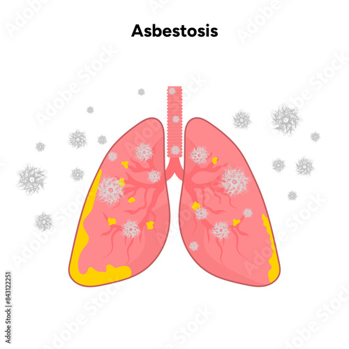 Asbestosis lungs diseases, lungs problem