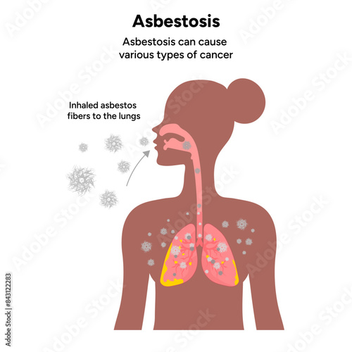 Asbestosis lungs diseases, lungs problem