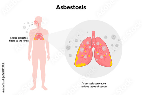 Asbestosis lungs diseases, lungs problem