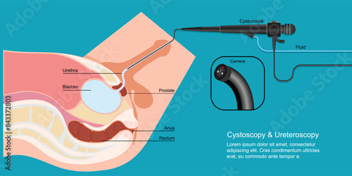 Cystoscopy allows a health care provider to view the lower urinary.