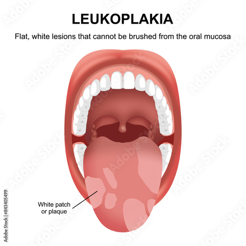 Leukoplakia white patch on mouth illustration