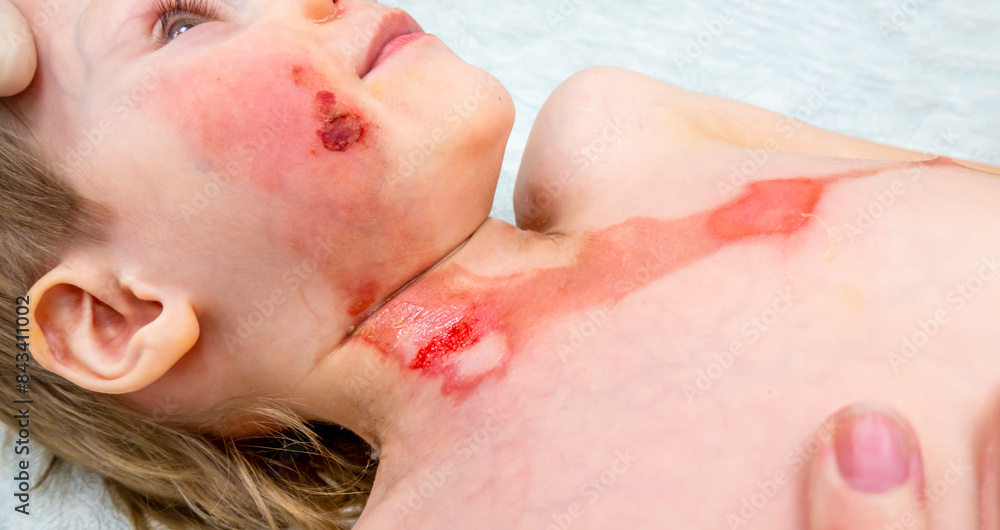 medical procedure dressing a boy with a first-degree burn from boiling water on his face, neck and chest