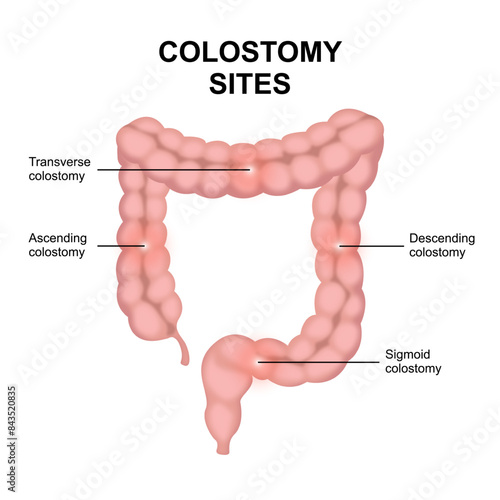 Colostomy Sites colon cancer illustration