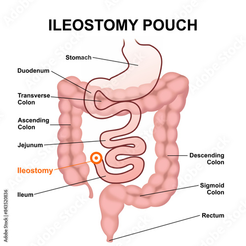 Ileostomy Pouch Vector Medical Illustration