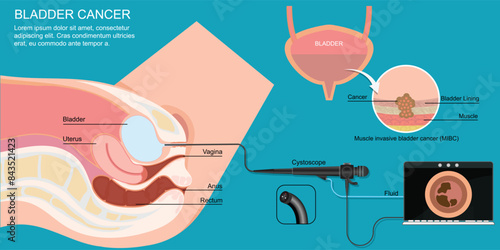 Evaluation of diagnostic strategies for bladder cancer using cystoscopy.