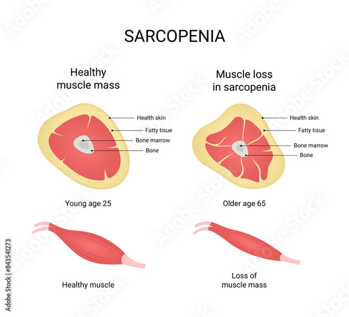 Vector illustration of healthy muscle mass and muscle loss in sarcopenia