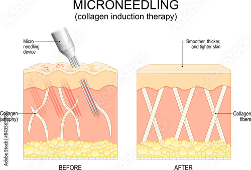 Microneedling procedure. Skin rejuvenation