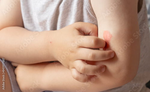 Allergic reaction on the skin. childhood allergies, insect bites, food allergies. bloody spots on the skin. itchy skin