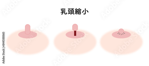 乳頭縮小_高さ