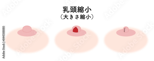 乳頭縮小_大きさ