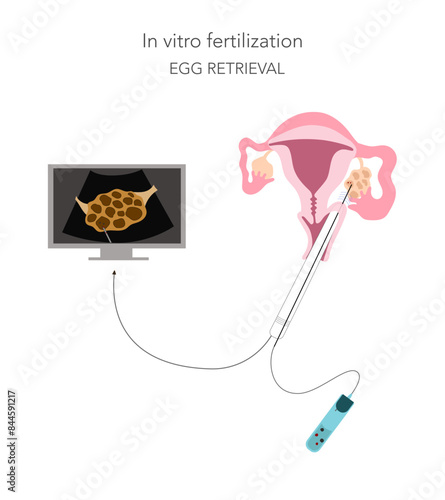 In vitro fertilization step of eggs retrieval from stimulated ovary under the control of ultrasound.