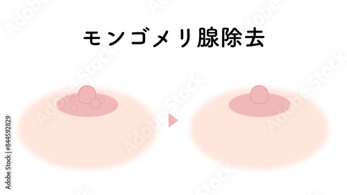 モンゴメリ腺