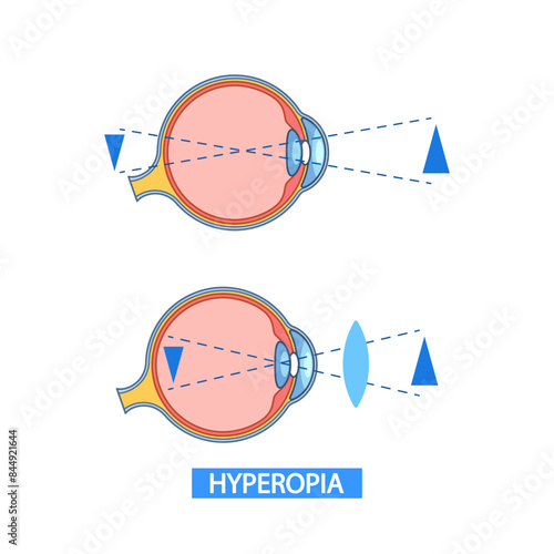 Informative Vector Infographic Depicting Hyperopia, Illustrating The Difference Between A Normal And Farsighted Eye