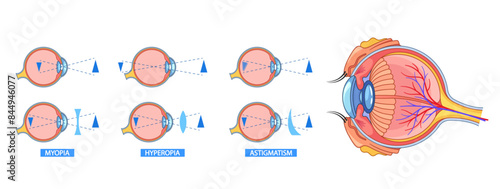 Detailed Eye Anatomy Infographic Explaining Myopia, Hyperopia, And Astigmatism. Visual Representation Of Eye Structure