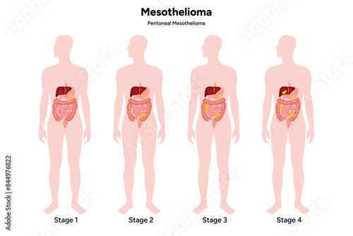 Mesothelioma disease, Pericardial mesothelioma	

