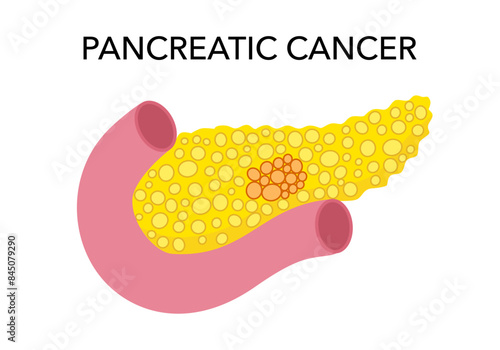 Pancreatic cancer concept on white background.