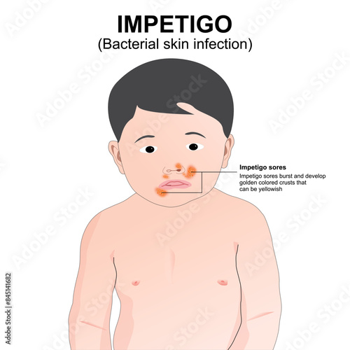 Impetigo on kids illustration of bacterial skin infection