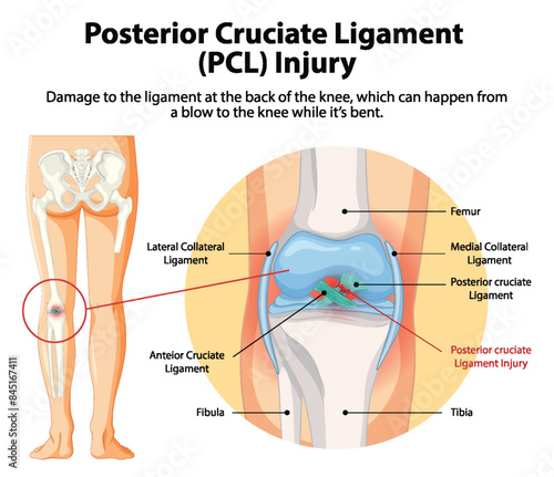 Illustration of PCL injury in the knee
