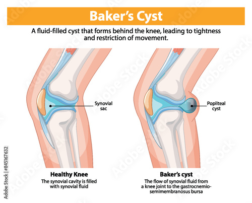 Comparison of healthy knee and Baker's cyst