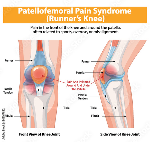 Diagram showing knee pain and inflammation details