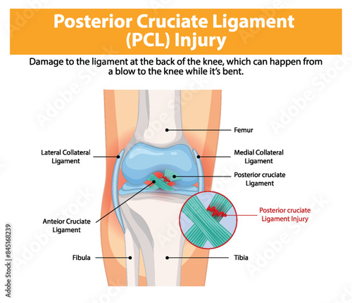Illustration of PCL injury in the knee joint