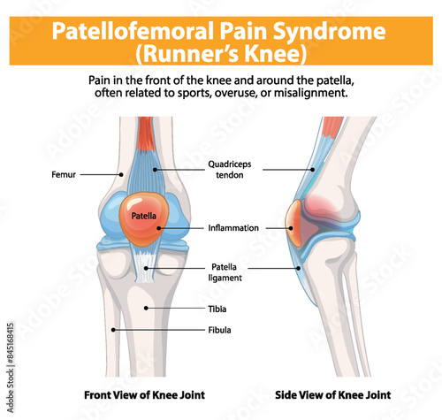 Detailed diagram of knee joint with inflammation