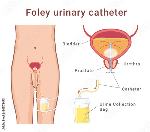 Male Foley urinary catheter medical scheme educational diagram design template vector flat