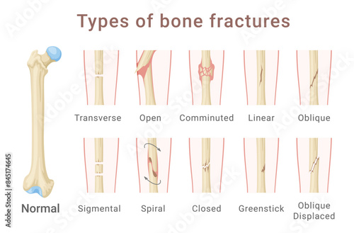 Types of femoral shaft bone fracture medical scheme infographic isometric vector illustration photo