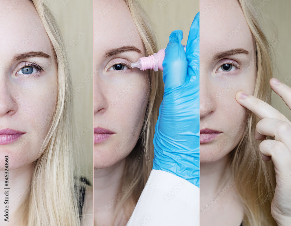 Mydriatic Before and after eye drops to examine the fundus, pupil dilation. A ...