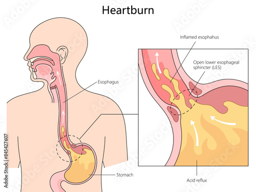 anatomy of heartburn and acid reflux, with labeled parts of the esophagus and stomach diagram hand drawn schematic vector illustration. Medical science educational illustration photo