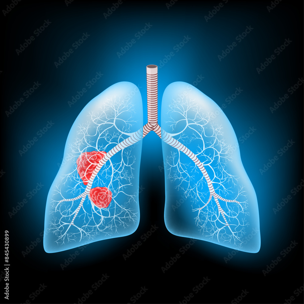 Tableau sur toile Lung cancer