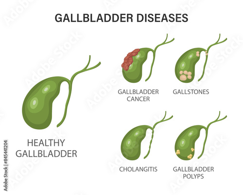Gallbladder diseases infographics. Gallstone disease, cancer, acute cholecystitis, cholangitis or polyps of the digestive system. Problems with the biliary tract. Illustration.