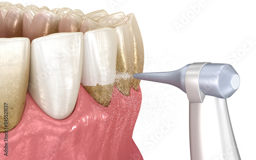 Oral hygiene: Air flow water Teeth Cleaning. Medically accurate 3D installation of human teeth treatment photo