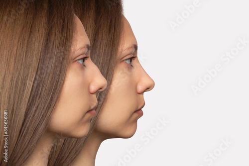 Konstfotografi Collage before and after plastic surgery on the nose, isolated on a white background