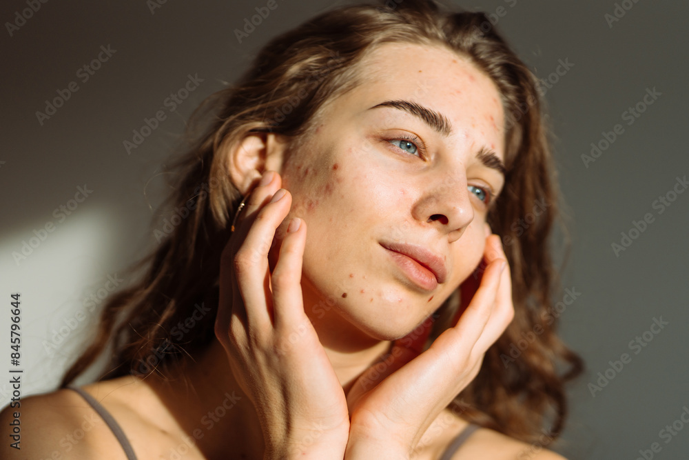 Acne on woman's face with rash skin ,scar and spot that allergic to cosmetics. Medicine and cosmetology concept. Natural skin. Acne on woman's face with rash skin ,scar and spot that allergic to cosmetics. Medicine and cosmetology concept. Natural skin.