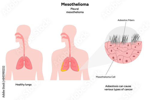Mesothelioma disease, Pleural mesothelioma