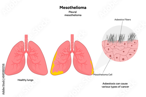 Mesothelioma disease, Pleural mesothelioma
