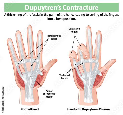 Comparison of normal hand and affected hand