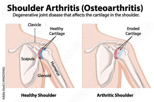 Healthy vs. arthritic shoulder joint diagram