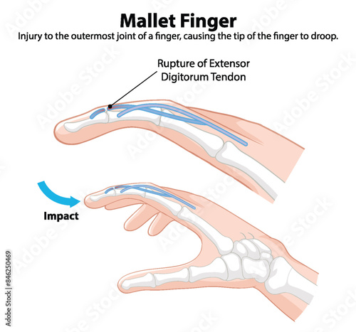 Diagram showing mallet finger injury details