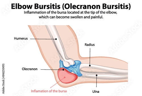 Diagram showing inflammation of elbow bursa