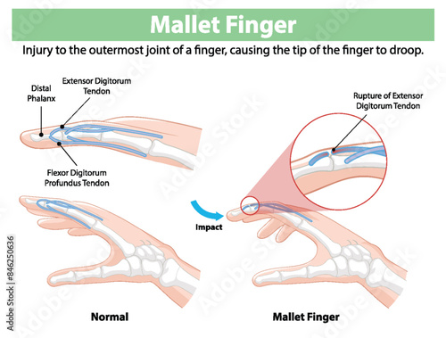 Depicts normal and mallet finger conditions
