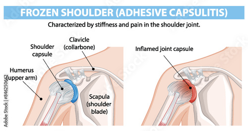 Diagram showing frozen shoulder condition and anatomy