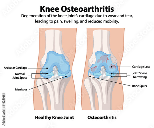 Healthy knee joint vs osteoarthritis knee joint