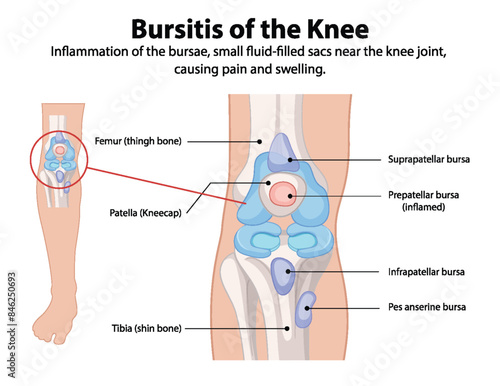 Inflammation of knee bursae causing pain and swelling