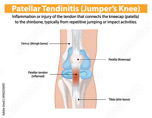 Inflammation of the tendon connecting kneecap to shinbone