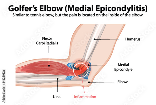 Detailed diagram of medial epicondylitis in the elbow